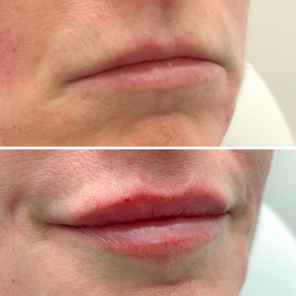 Lipflip Botox en Fillers in Leiden Kliniek Vinci