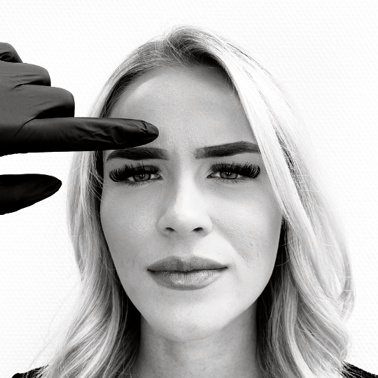 botox frons fronsrimpel