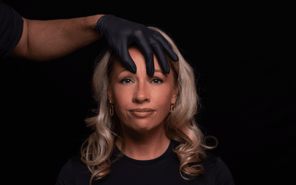 botox frons fronsrimpel