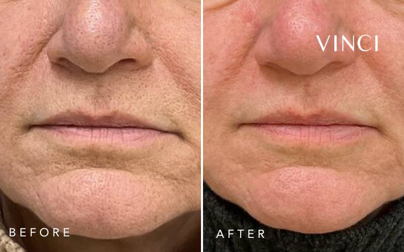 polynucelotide (PDRN, Zalm DNA) voor en na foto met verbeterde huidstructuur