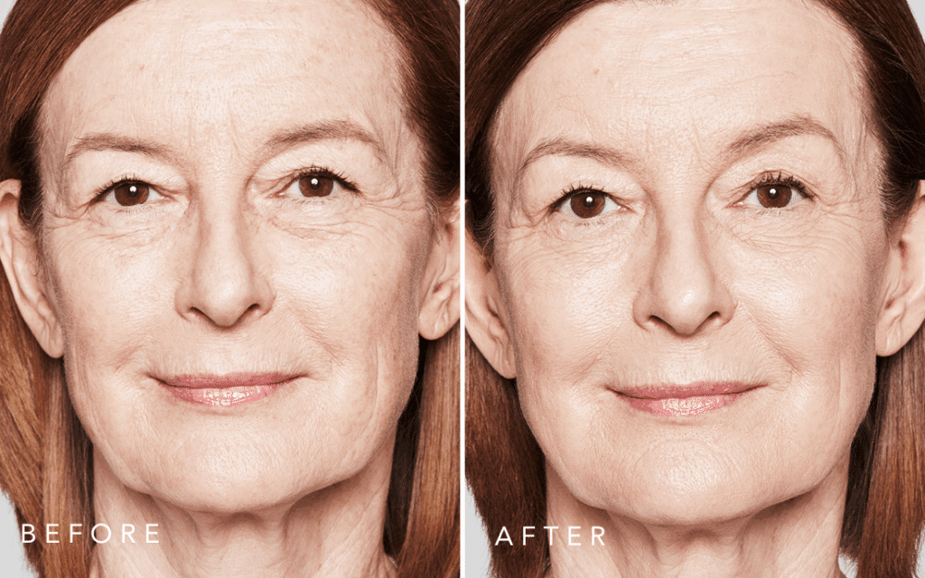 sculptra before after