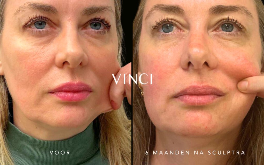 Sculptra voor en na resultaat na 6 maanden bij Kliniek Vinci Leiden - Huidverstrakking en collageenopbouw