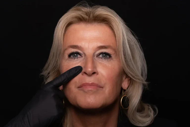 Traangootfillerbehandeling bij Kliniek Vinci in Leiden