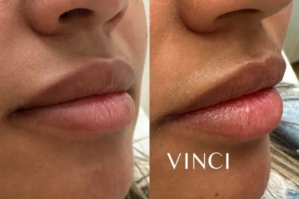 Bovenlip met verschoven filler boven de liprand, en dezelfde lip na behandeling